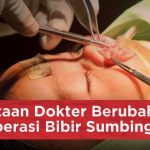 Operasi Rekonstruksi Sumbing Langkah Menuju Percaya Diri