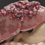 Sakit Tumor Pertumbuhan Sel Yang Tidak Terkendali