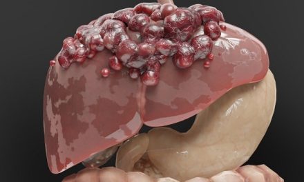 Sakit Tumor Pertumbuhan Sel Yang Tidak Terkendali