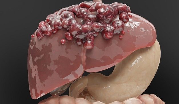 Sakit Tumor Pertumbuhan Sel Yang Tidak Terkendali
