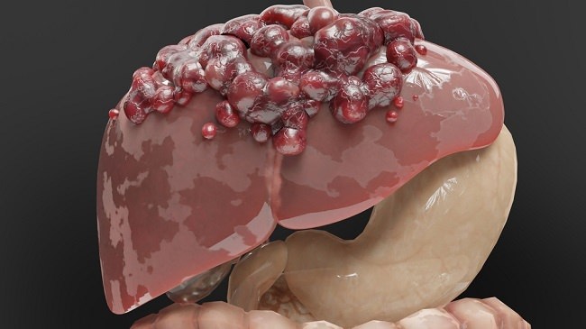 Sakit Tumor Pertumbuhan Sel Yang Tidak Terkendali